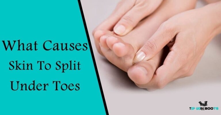 What Causes Skin To Split Under Toes 